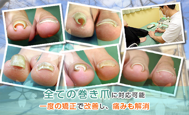 当院の技術であれば軽度から重度まで爪の状態に関係なく'痛みを取り'、'正常な爪の形'に修復させることが可能です。