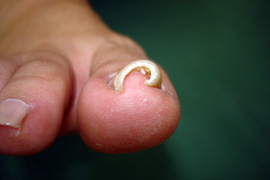 代表的な巻き爪矯正の症例2